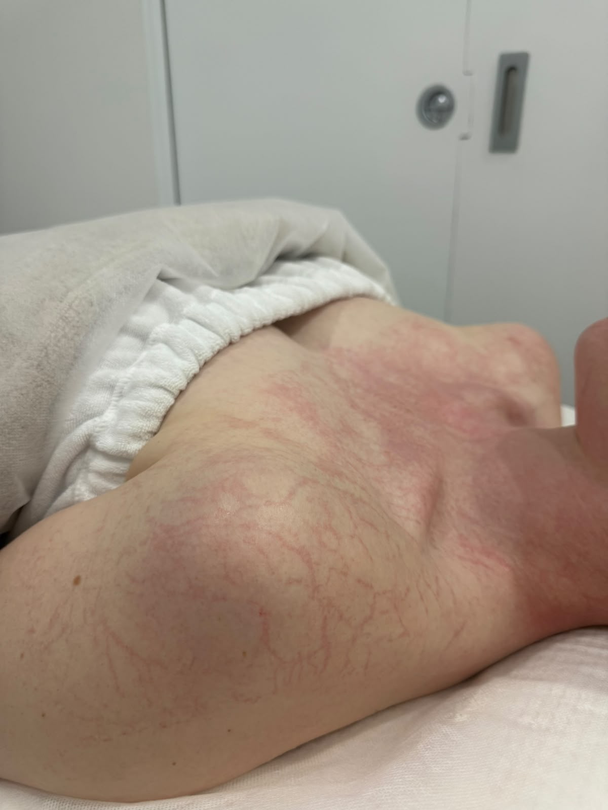 DMK Plasmatic Effect detail on the back after DMK Enzyme Therapy Close-up of the DMK Plasmatic Effect, a temporary vein-like network of red lines, across a client's back and shoulder immediately after DMK Enzyme Therapy at Soraya Skin Clinic