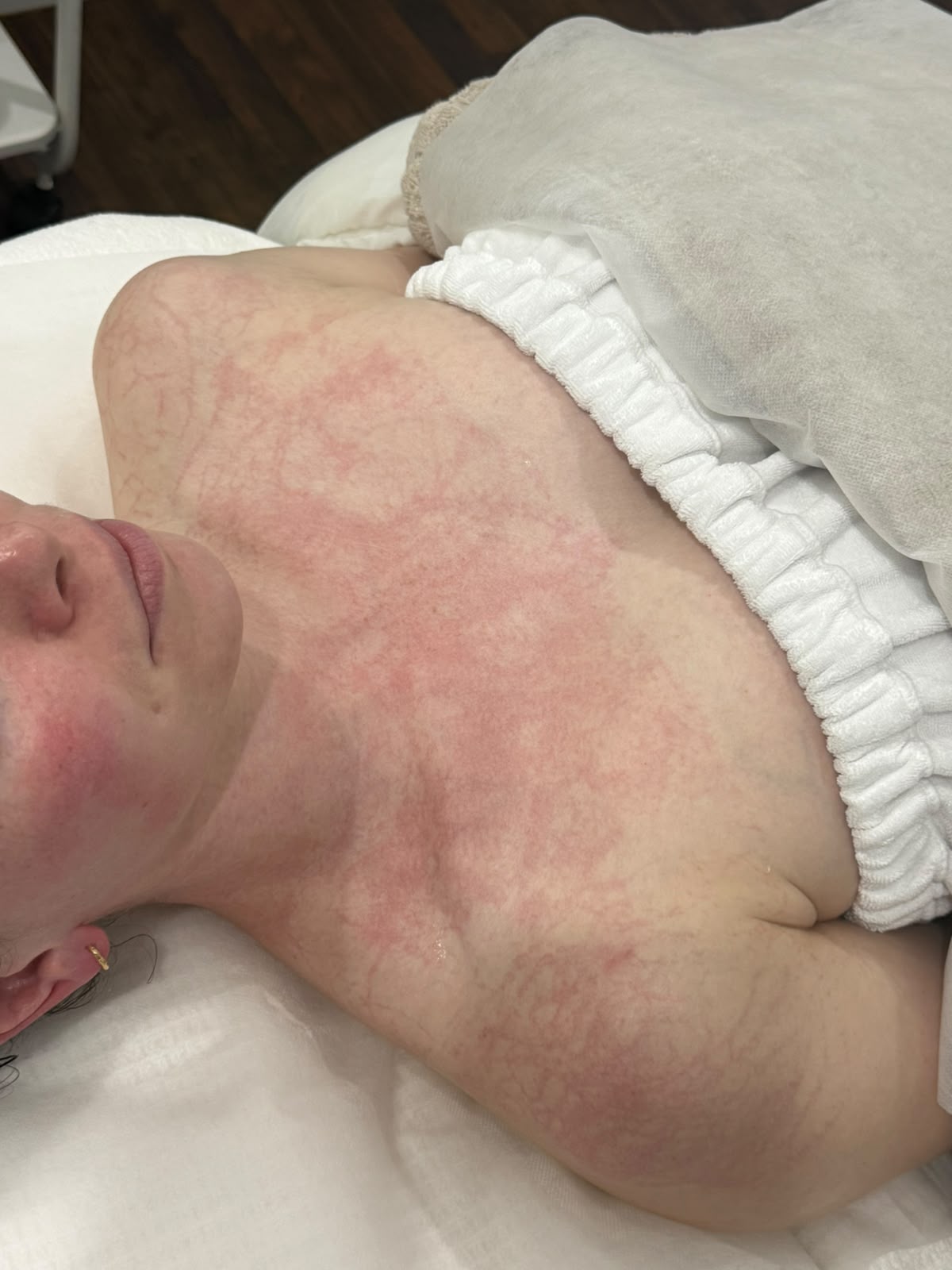 DMK Plasmatic Effect across the chest after DMK Enzyme Therapy DMK Plasmatic Effect showing a temporary vein-like network of red lines across a client's chest and décolletage immediately after DMK Enzyme Therapy at Soraya Skin Clinic