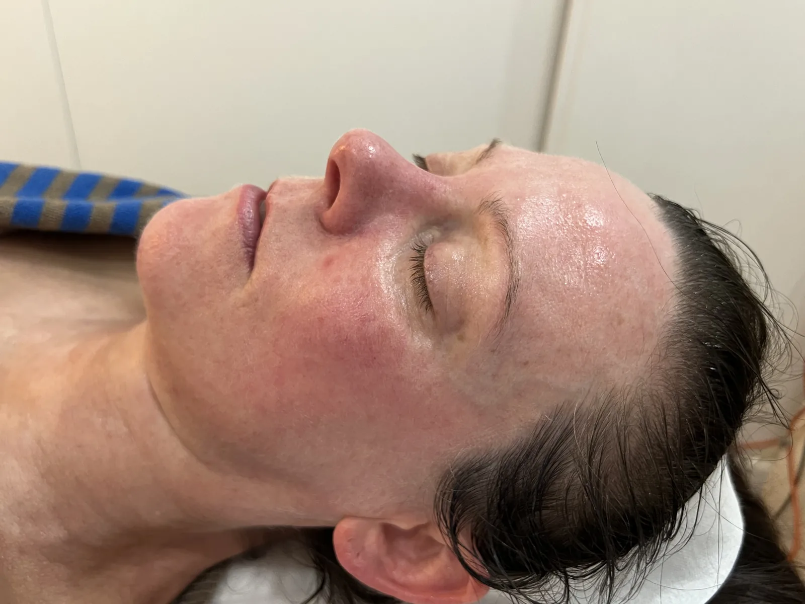After BioRePeel treatment, client result one Client's skin after BioRePeel treatment at Soraya Skin Clinic Melbourne, with a brighter, smoother and more even complexion