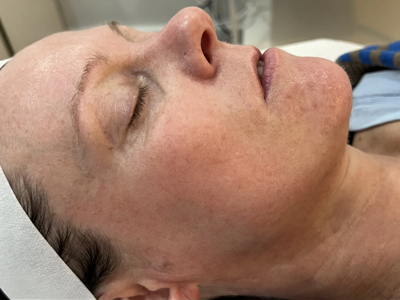 Before BioRePeel treatment, client result two Client's facial skin before a course of BioRePeel peels at Soraya Skin Clinic