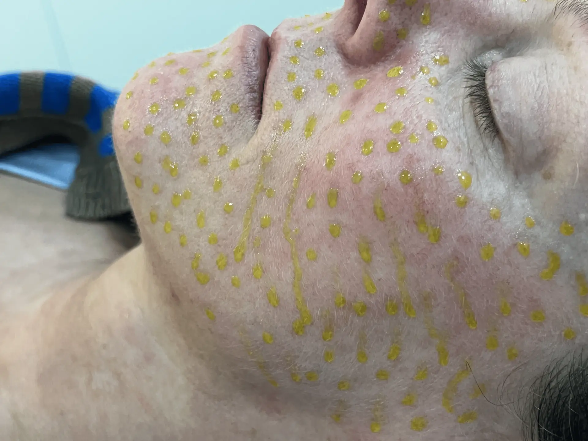 BioRePeel facial application close-up two Detailed close-up of BioRePeel solution applied to a client's cheek, chin and nose at Soraya Skin Clinic