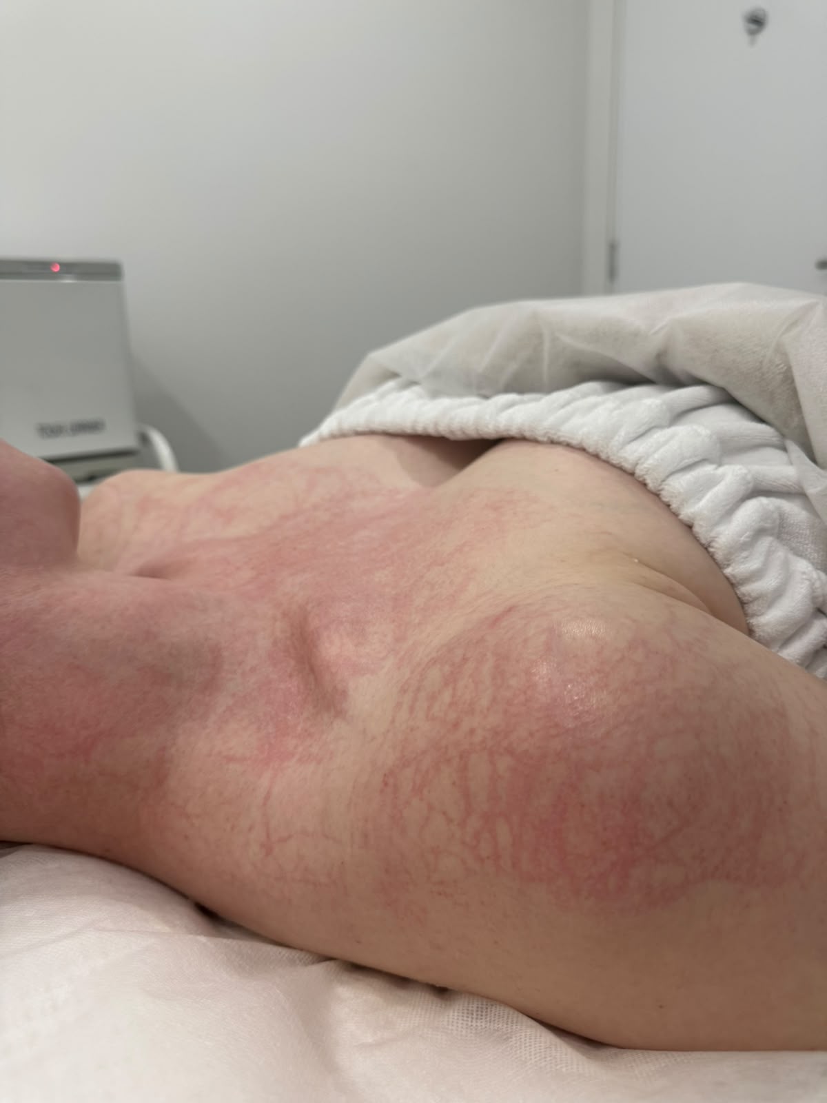 DMK Plasmatic Effect across the back and shoulders after DMK Enzyme Therapy DMK Plasmatic Effect appearing as a temporary vein-like network of red lines across a client's back and shoulders immediately after DMK Enzyme Therapy at Soraya Skin Clinic