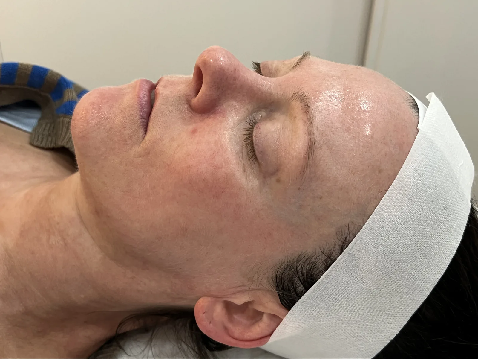 Before BioRePeel treatment, client result one Client's skin before a BioRePeel treatment at Soraya Skin Clinic Melbourne, showing congestion and uneven tone