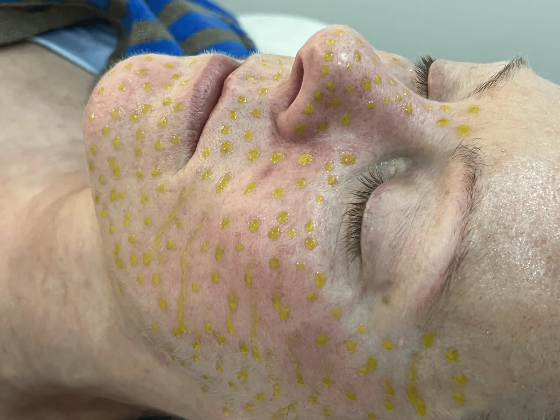 BioRePeel facial application close-up one Close-up side view of BioRePeel solution dotted across a client's face during treatment at Soraya Skin Clinic