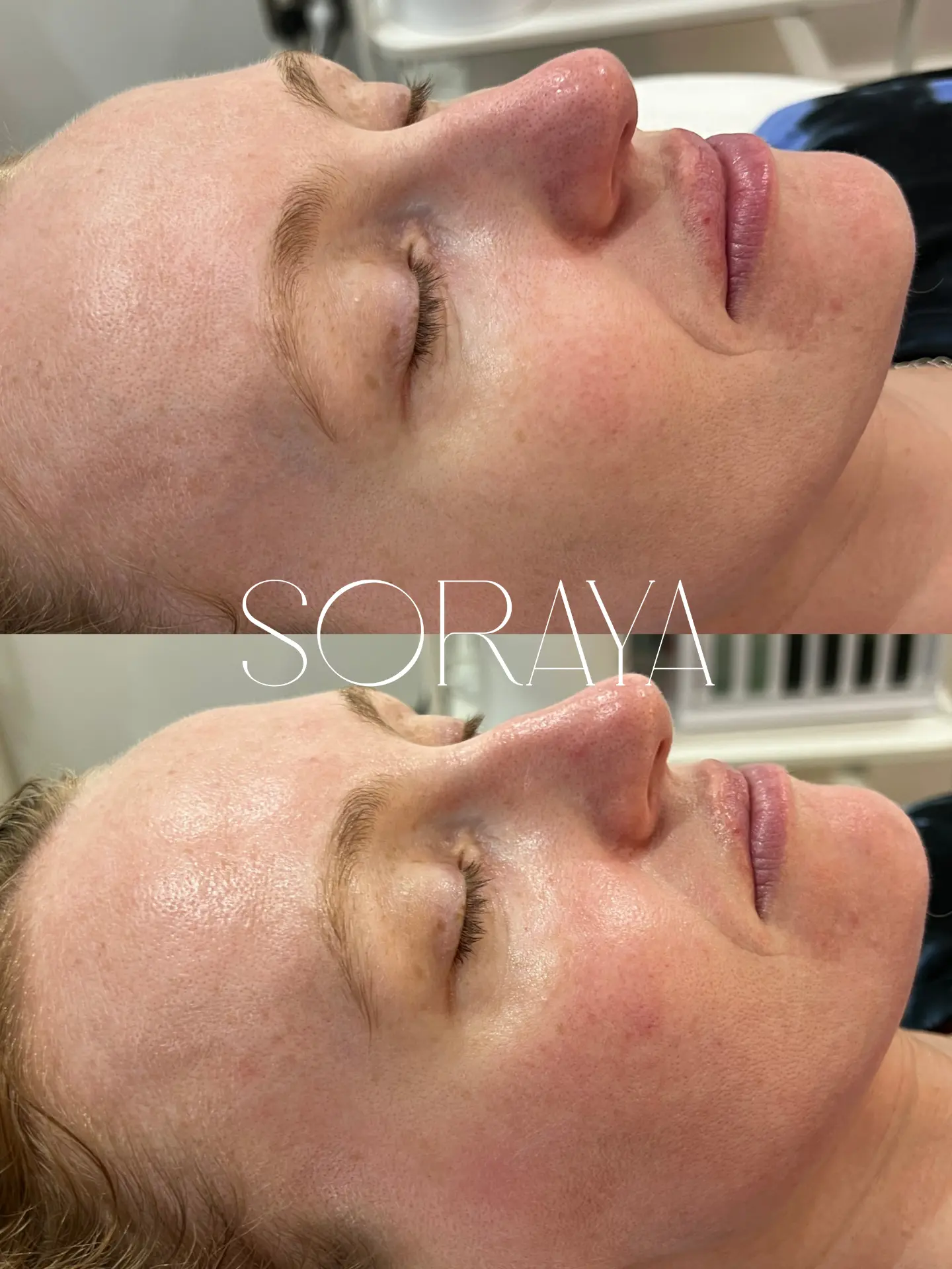 DMK Enzyme Therapy before and after client result two Combined before and after side-profile views showing a client's skin response to DMK Enzyme Therapy at Soraya Skin Clinic