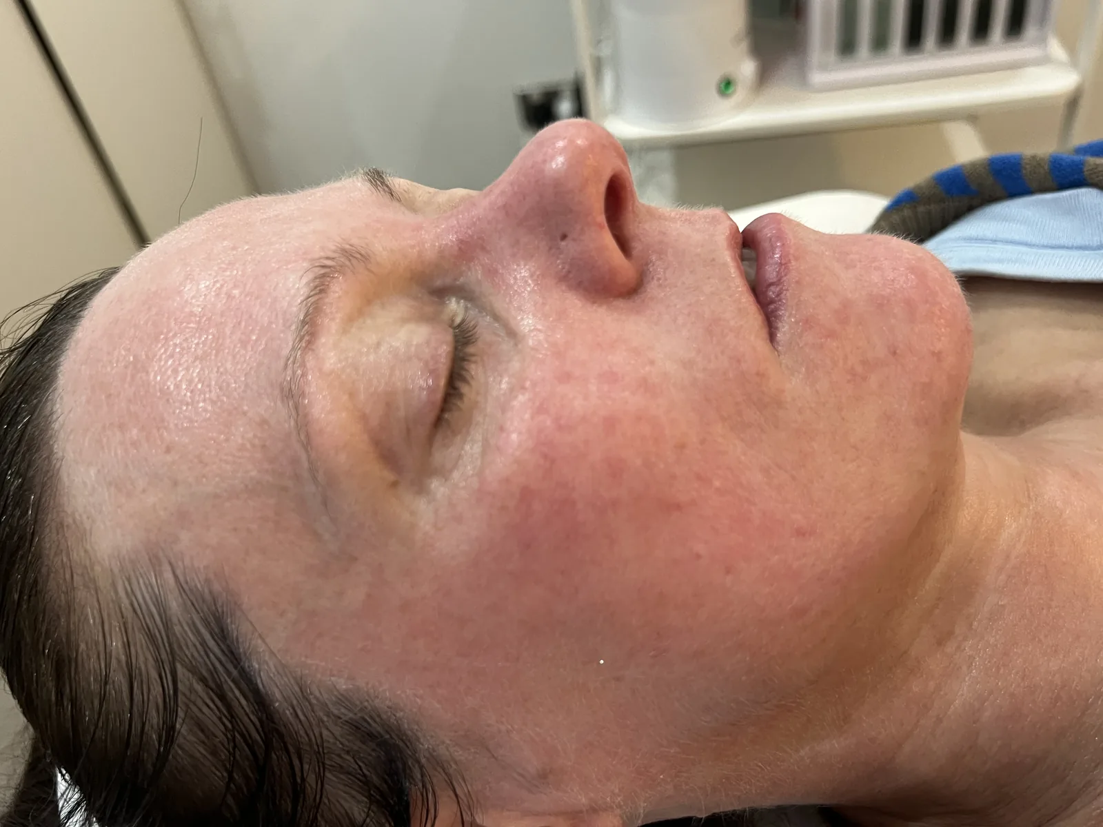 After BioRePeel treatment, client result two Client's facial skin after a course of BioRePeel peels at Soraya Skin Clinic, showing a clearer, more radiant complexion