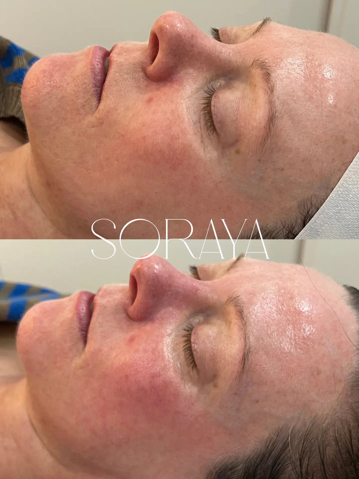 DMK Enzyme Therapy before and after client result one Combined before and after facial views showing a client's skin response to DMK Enzyme Therapy at Soraya Skin Clinic