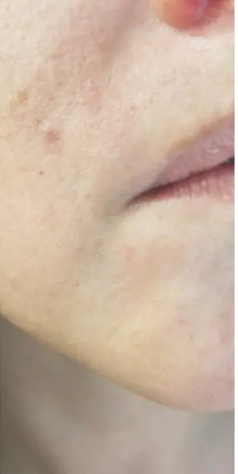 Skin showing visible improvement after DMK Enzyme Therapy treatment