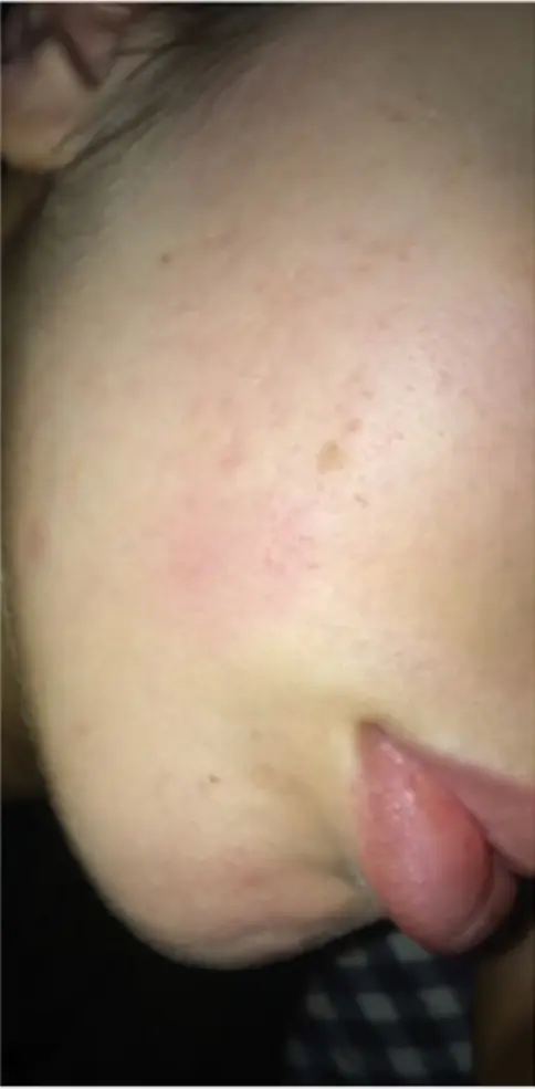 Skin showing visible improvement after DMK Enzyme Therapy treatment