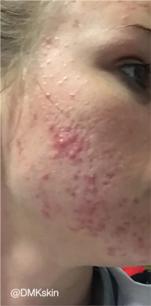 Skin condition before DMK Enzyme Therapy treatment