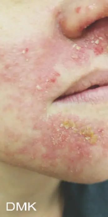 Skin condition before DMK Enzyme Therapy treatment