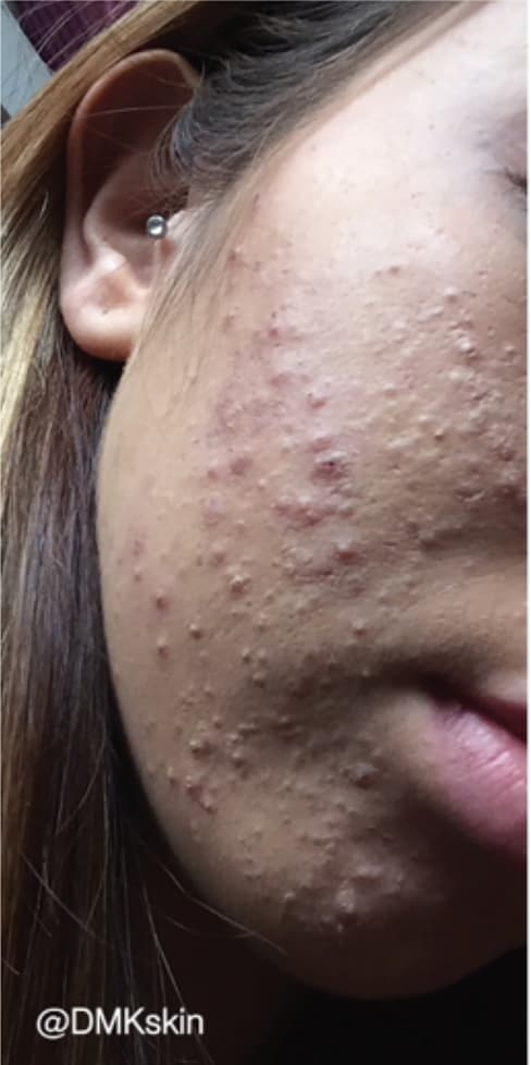 Skin condition before DMK Enzyme Therapy treatment