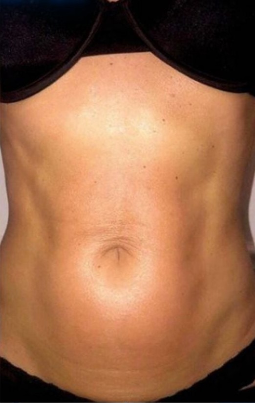 After CoolSlimming 360° cryolipolysis fat freezing on tummy at Soraya Skin Clinic Prahran, Melbourne