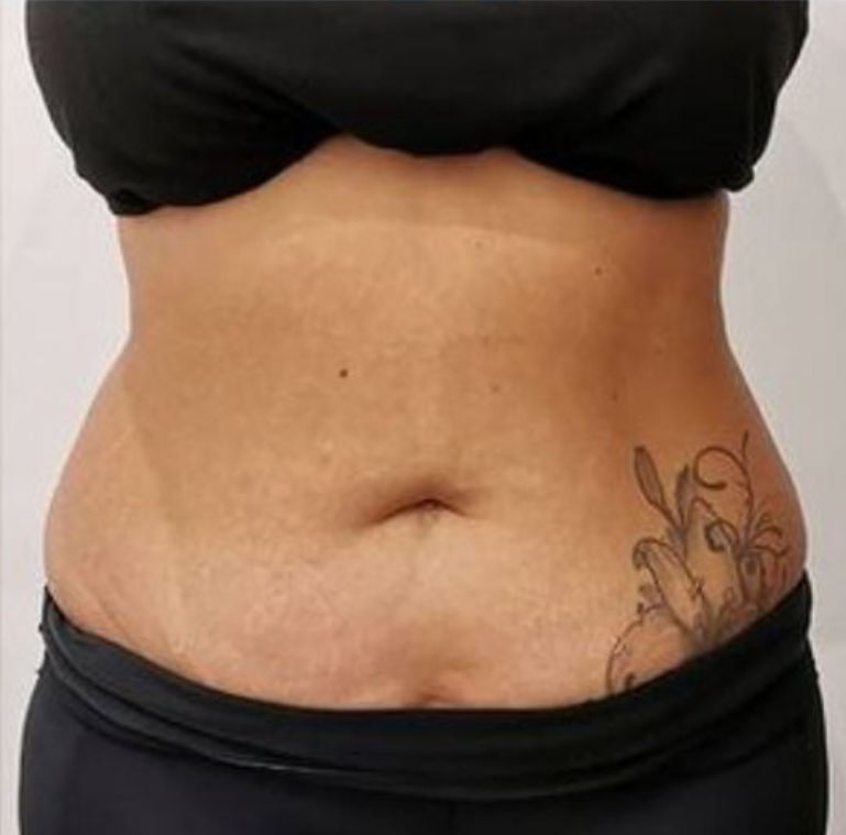 After CoolSlimming 360° cryolipolysis fat freezing on flanks at Soraya Skin Clinic Prahran, Melbourne