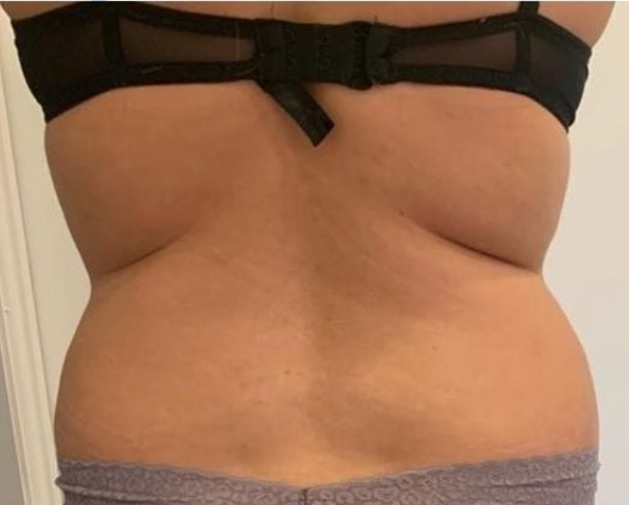 After CoolSlimming 360° cryolipolysis fat freezing on love handles at Soraya Skin Clinic Prahran, Melbourne