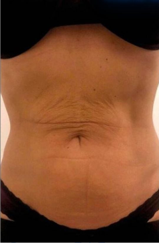 Before fat freezing on tummy at Soraya Skin Clinic Prahran, Melbourne