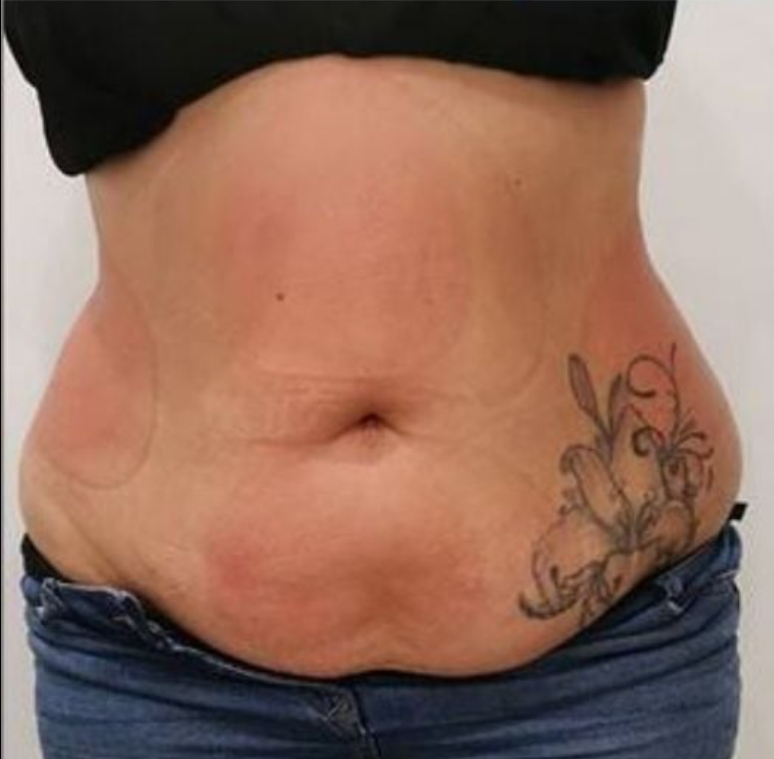Before fat freezing on flanks at Soraya Skin Clinic Prahran, Melbourne