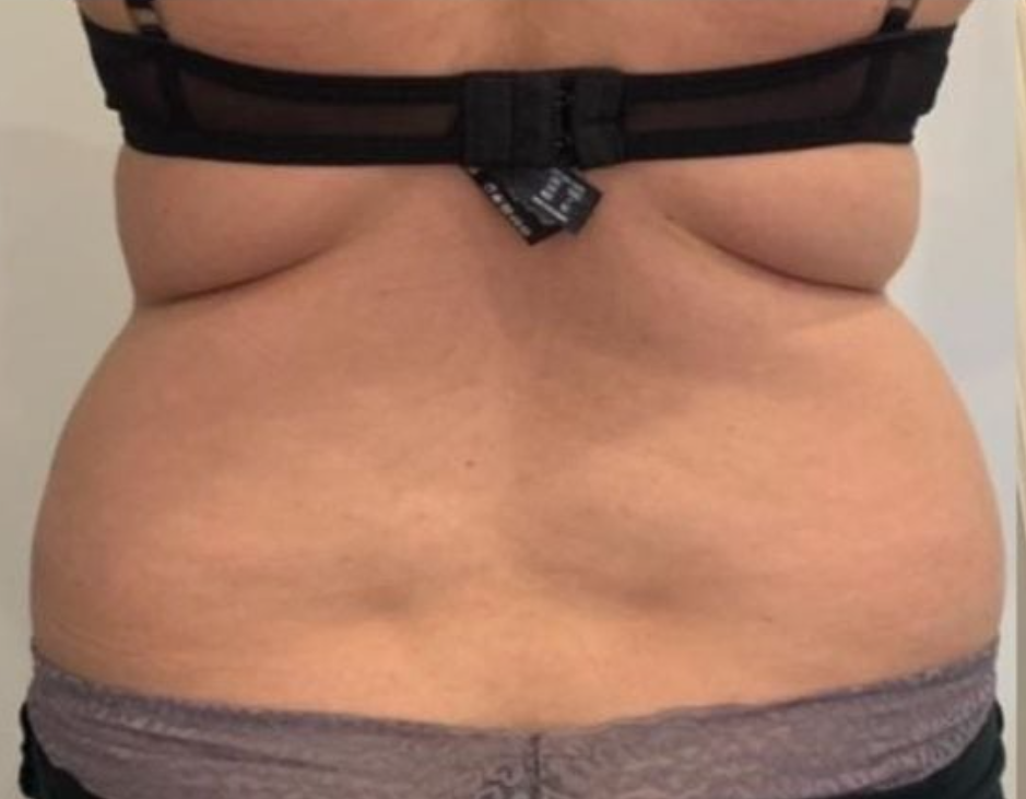 Before fat freezing on love handles at Soraya Skin Clinic Prahran, Melbourne